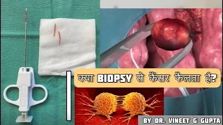 Does biopsy of tumor cause cancer to spread? - DM(AIIMS) - FNAC does not accelerate cancer 2023