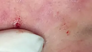 Relax  every day with Loan Nguyen,Relaxing blackheads removal #115