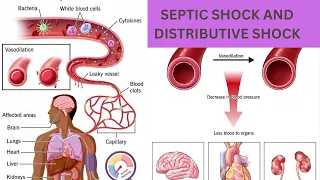Distributive Shock, It's Causes And Management||Septic Shock And its Causes||Classification Of Shock
