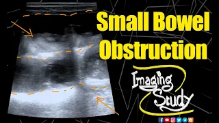 Small Bowel Obstruction || Ultrasound || Case 153