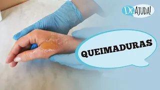 QUEIMADURAS: O QUE FAZER, COMO AVALIAR O GRAU, SINAIS DE ALERTA E DICAS PARA EVITAR