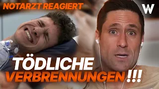 Arzt reagiert: Verletzungen in der Küche! Schwere Verbrennungen beim Pommes machen [Reaction SWR]