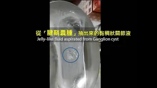 Ganglion cyst needle aspiration (腱鞘囊腫抽吸 )