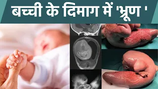 1 Year Old Baby के Brain में मिला Unborn Twin,China Mystery Viral | Boldsky
