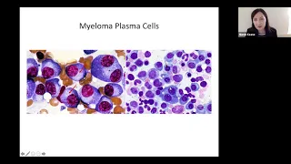 Overview of multiple myeloma