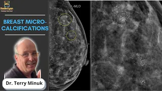 Mastering Mammography: Understanding Breast Micro-calcifications | Dr. Terry Minuk