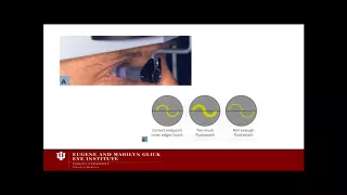 Introduction to Glaucoma