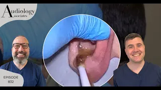 IRRIGATION OF HARD EAR WAX PLUG & STUCK O-TIP EXTRACTION- EP832