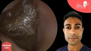 1,322 - Completely Sealed & Impacted Ear Wax Removal