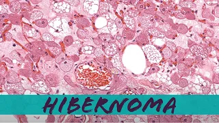 Hibernoma (benign brown fat tumor) pathology dermpath dermatology dermatopathology