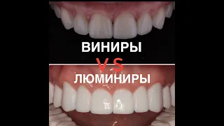 Люминиры или виниры? Что лучше?