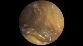 808 - Ear Wax Removal Clinic Compilation (18/10/21)