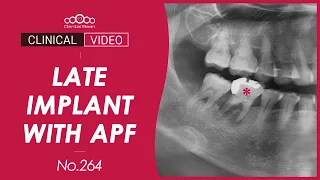 #46 Late implant placement with APF - [Dr. Cho Yongseok]