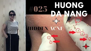 #025 | Get HIDDEN ACNE | Lấy mụn ẩn | Hương Đà Nẵng