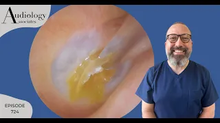 EXCESS SKIN STUCK TO THE EARDRUM  - EP724