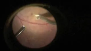 Eye Parasite Removal