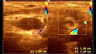 Submandibular abscess | Parotid Gland swelling | Enlarge Lymph Node