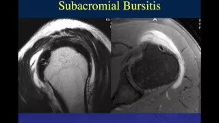 Shoulder | Impingement Pt  1