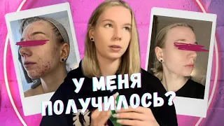 ТАК ТЫ ТОЧНО НЕ ИЗБАВИШЬСЯ ОТ АКНЕ// моя история//средства, витамины, косметологи