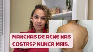 ANTES E DEPOIS MANCHA DE ACNE NAS COSTAS - Após apenas 2 Sessões