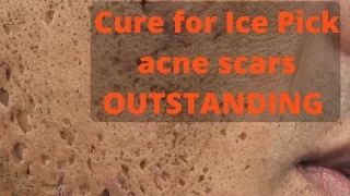 How to treat ice pick acne scars