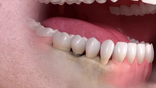 Trattamento singolo dente su impianto