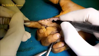 Post Burn Finger Contracture Correction With Palmar Flaps