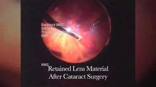 Floaters Retained Lens Material-Barnet Dulaney Perkins Eye Center (AZ)