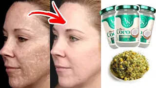 Como CLAREIA MANCHAS NA PELE Inclusive MELASMA e Olheiras!