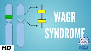 WAGR syndrome, Causes, Signs and Symptoms, DIagnosis and Treatment.