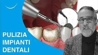 Come gli pulire impianti dentali - Prof. Makarati a Dica33 - Telearena