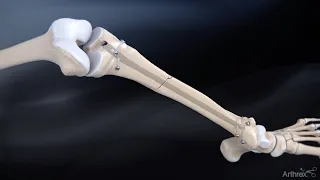 Tibial Nail System—Standard Surgical Technique