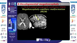 Ifferential Diagnosis of Pediatric Macrocephaly