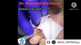 Tumor removal on alar part of nose