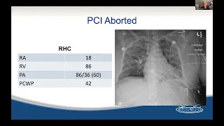 Hemodynamic Support for PCI: When and How?