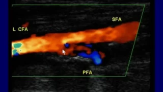 How to DoRead and Interpret the Arterial Duplex Exam