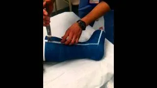 Marta's Cast Comes Off