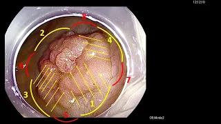 ESD of Rectal Polyp with HGD