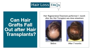 Can Hair Grafts Fall out After Hair Transplants?