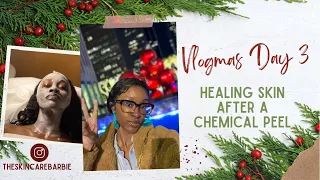 CHEMICAL PEEL HOW TO : HEALING THE SKIN AFTER A CHEMICAL PEEL, VLOGMAS DAY 3