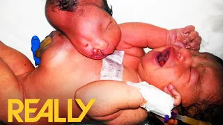 Baby Is Born With Two Heads After Parasitic Fetus Attaches Itself To Baby's Body | Body Bizarre