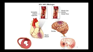 Overview of Cardiovascular Diseases & Emphasis of Preventative Strategies