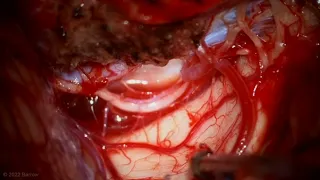 Far Lateral Craniotomy for Resection of a Foramen Magnum Meningioma