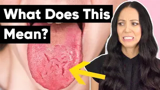 What Does a Cracked Tongue Mean?