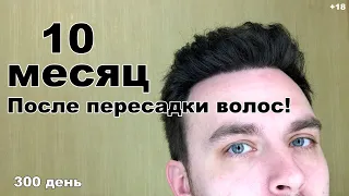 Пересадка волос 10 МЕСЯЦ. Отчет на 300 день Стамбул Турция.