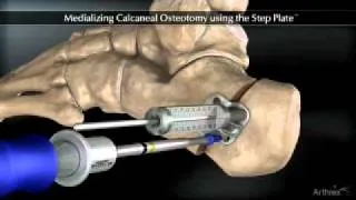 Medializing Calcaneal Osteotomy