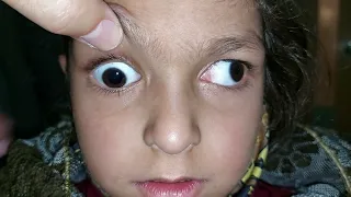 Third nerve palsy, pupil involving