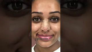 At home nose job??