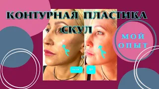 Контурная пластика . Увеличение скул филлером.