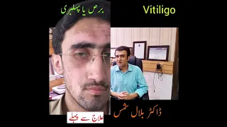 Vitiligo treatment | excimer laser | Dermatologist | Dr. Bilal Shams